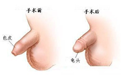 阳江小孩子的包皮包茎的危害