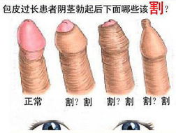 包茎